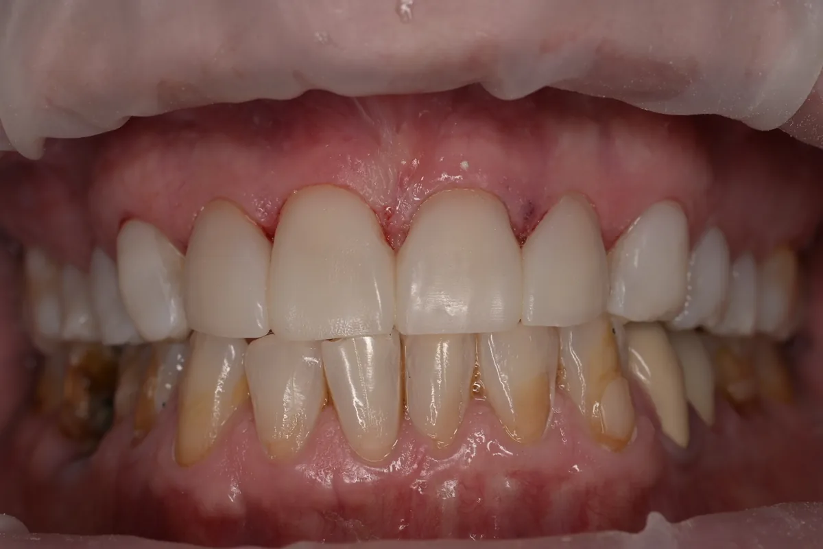 After upper composite bonding at MDRN Dental Studio