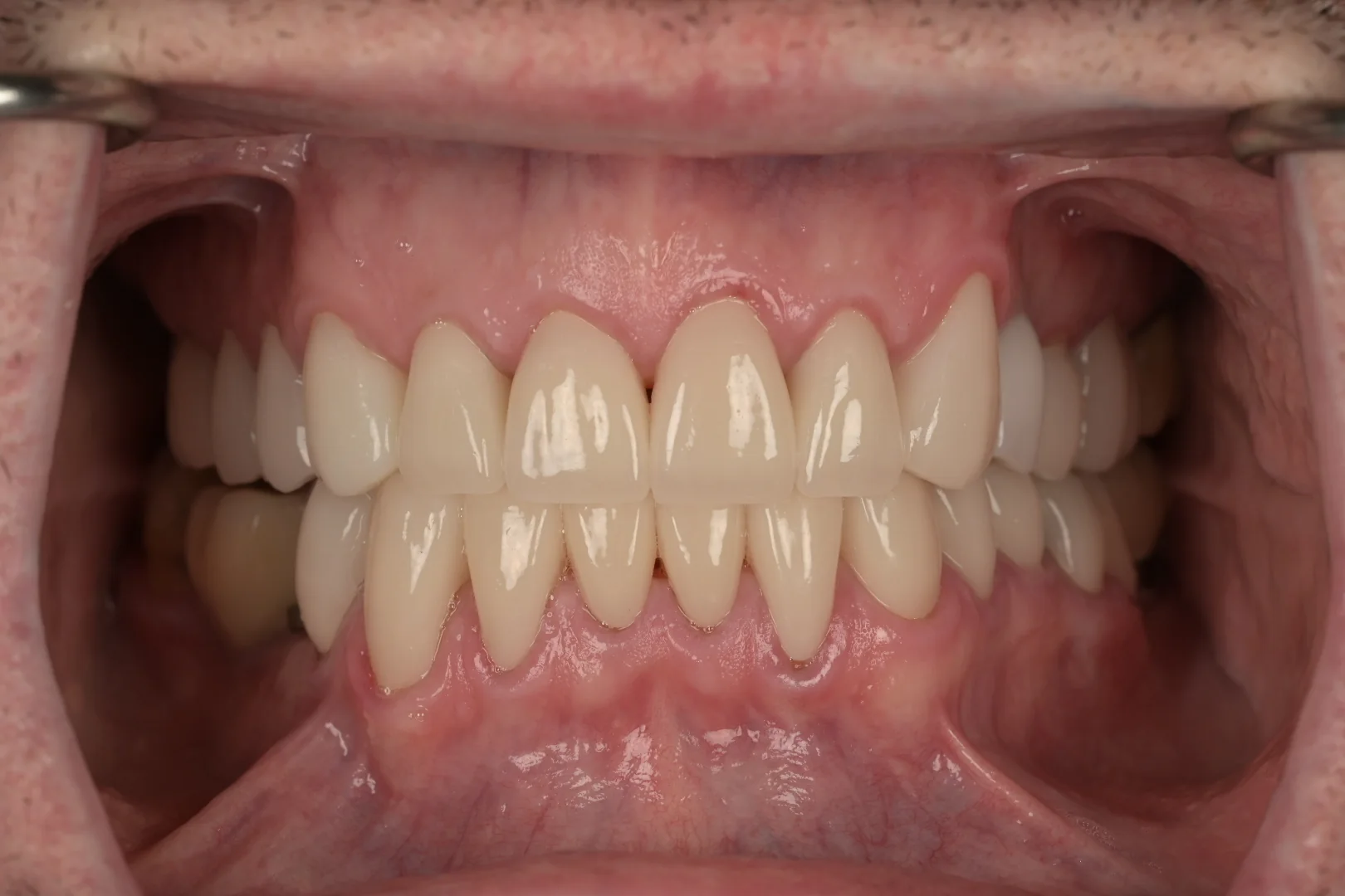 After comprehensive restorative dental care, actual MDRN Dental Studio patient close-up dental photo
